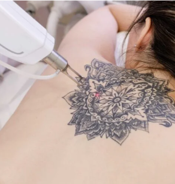 How Much Does Laser Tattoo Removal Cost? 
